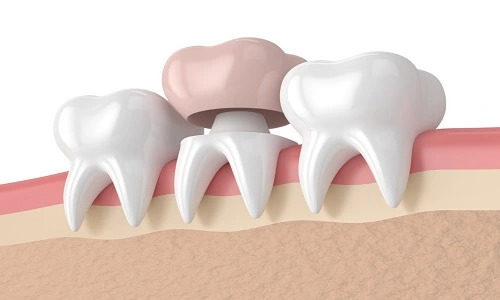 Dental Bridges