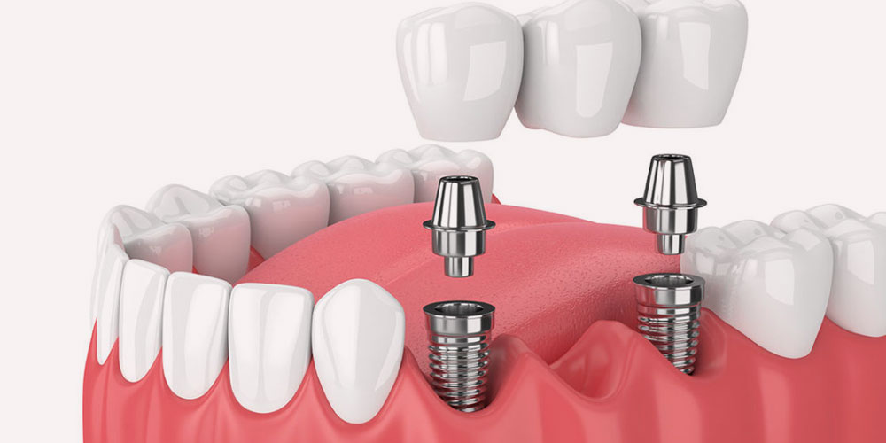 Dental Implants